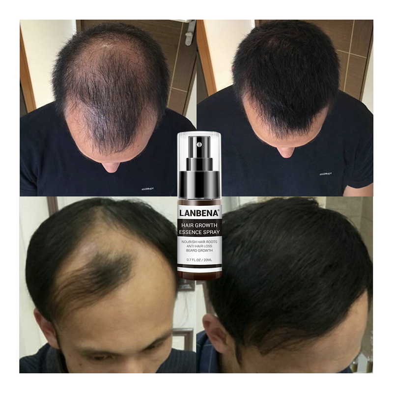 20ml Fast Hair Growth Essence Spray Anti Baldness Hair Treatment