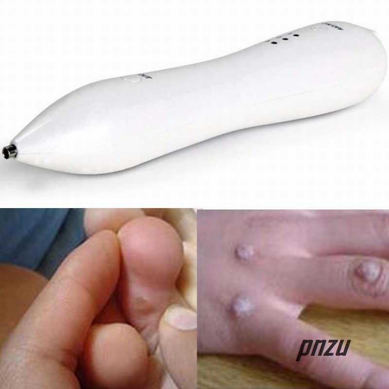 Skin Tag Remover Pen Pro for Warts Age Spots Tattoo Nevus ...